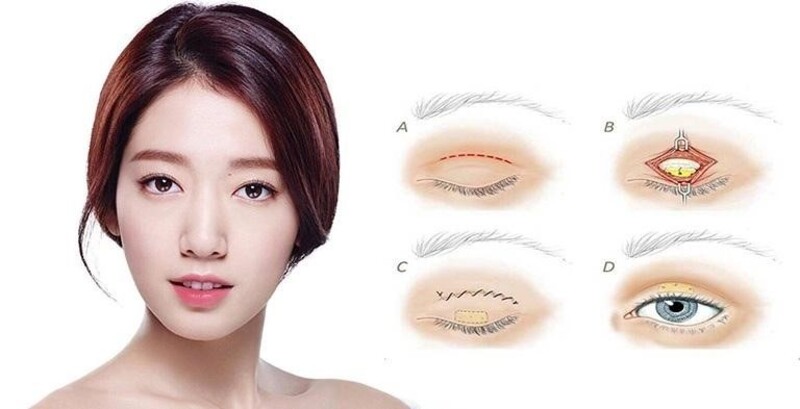 Cắt mí Hàn Quốc là thủ thuật rất được ưa chuộng hiện nay
