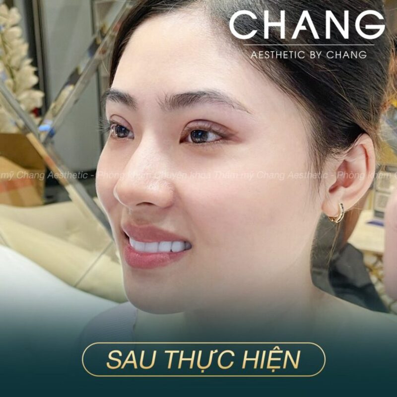 Cắt mí Mini Line khắc phục tình trạng đa nếp mí