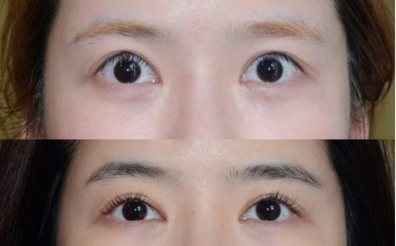 Chăm sóc hậu phẫu sai cắt khiến kết quả không như mong muốn