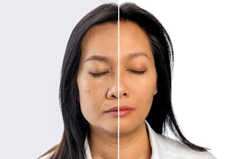 Cơ mặt mất khả năng nâng đỡ da gây nên tình trạng chảy xệ