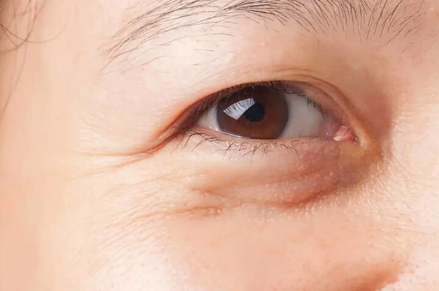 Dấu hiệu và nguyên nhân sụp mí mắt