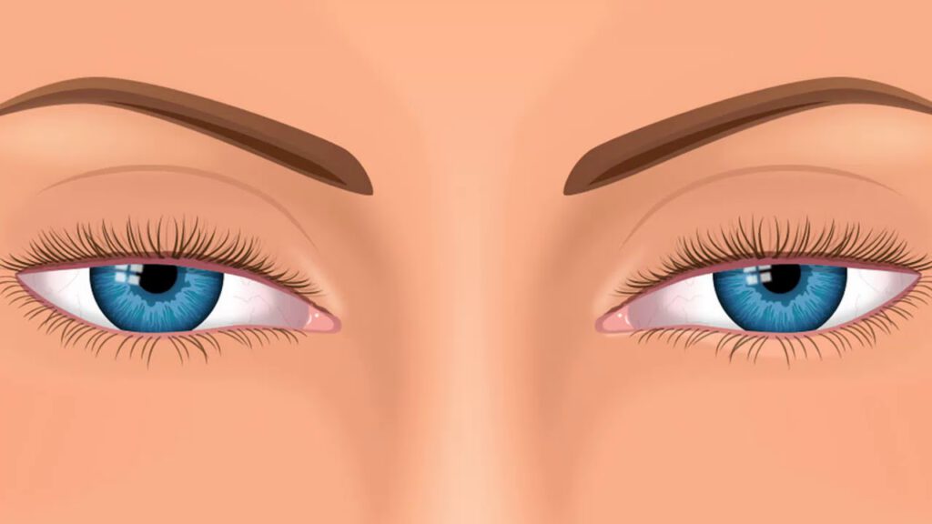 Nhận biết sụp mí dễ dàng thông qua quan sát đôi mắt thấy mí che đi một phần đồng tử