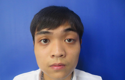 Sụp mí mắt 1 bên