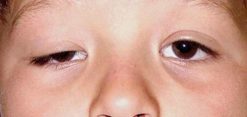 Nhiều trẻ em bị sụp mí mắt bẩm sinh