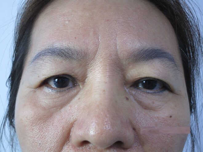 Lão hóa là một trong những nguyên nhân hàng đầu gây nên tình trạng sụp mí