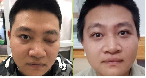 Chấn thương khiến mí mắt bị sụp