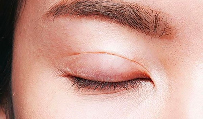 Cắt mí hỏng là một trong những nguyên nhân khiến mí mắt bị sụp so với bình thường