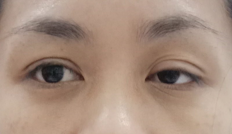 Mắt sụp mí gây cản trở tầm nhìn