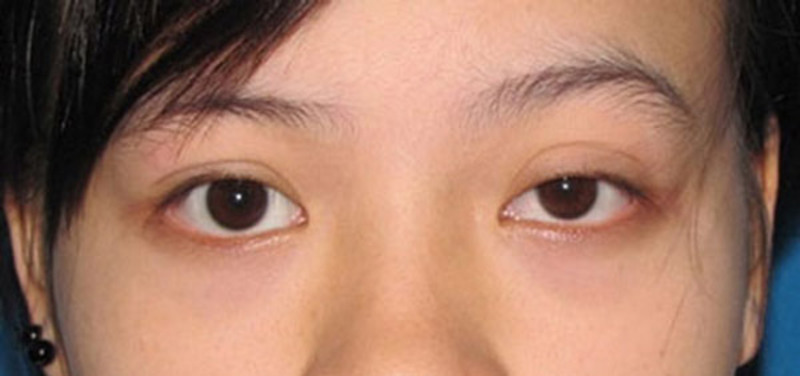 Hai nếp mí không đều nhau gây ảnh hưởng tới thẩm mỹ