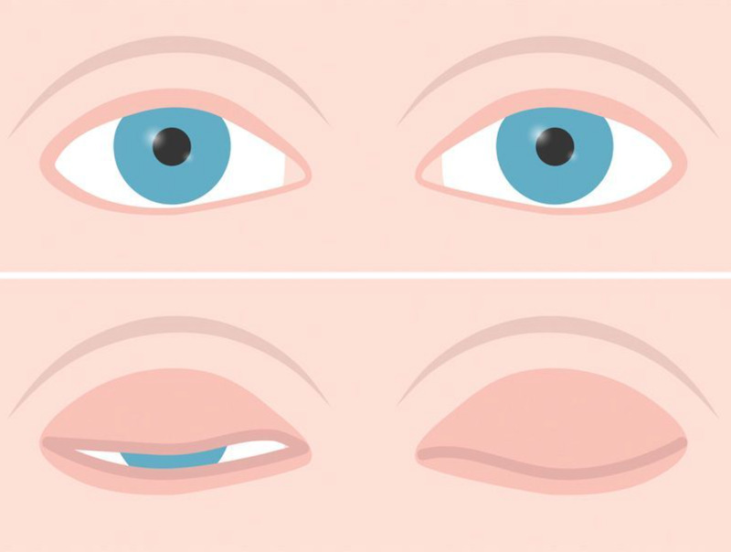 Hình ảnh cắt mí mắt bị hỏng khiến mắt nhắm không kín