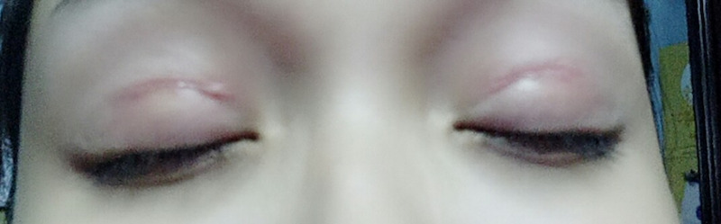 Khắc phục tình trạng cắt mí hỏng thành công khi tìm đến cơ sở thẩm mỹ uy tín