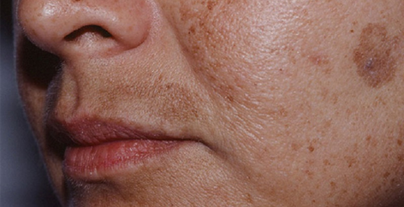 Khóe miệng xuất hiện những nếp nhăn rõ rệt