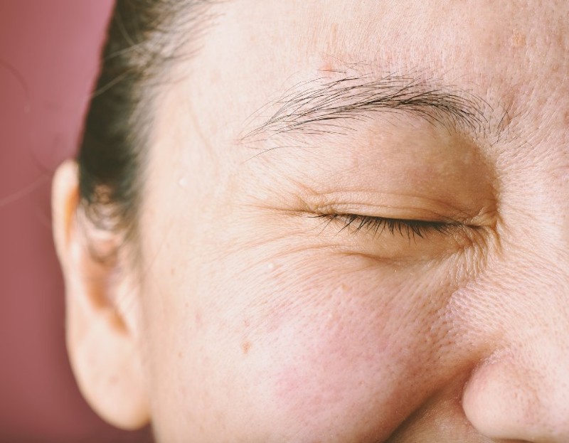 Làn da dần trở nên nhăn nheo và chảy xệ
