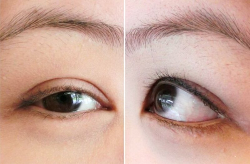 Mắt bị trợn do tay nghề bác sĩ kém