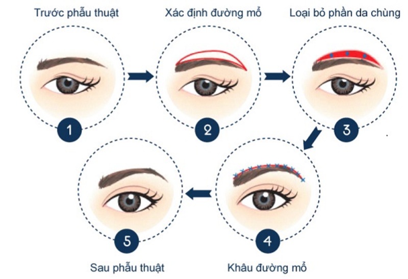 Nâng cung chân mày cải thiện tình trạng cắt mí hỏng