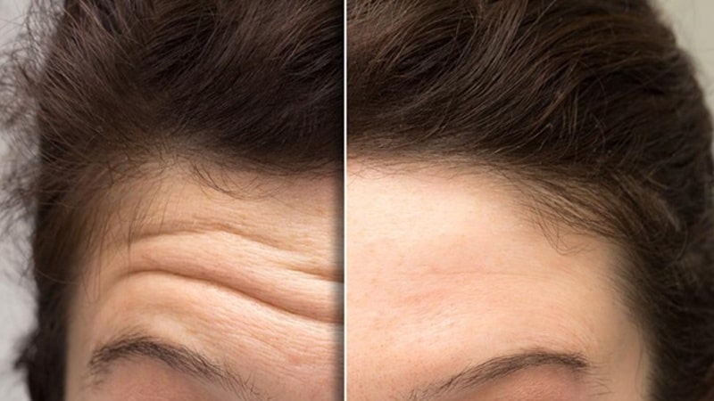 Nếp nhăn trán khó phục hồi theo thời gian