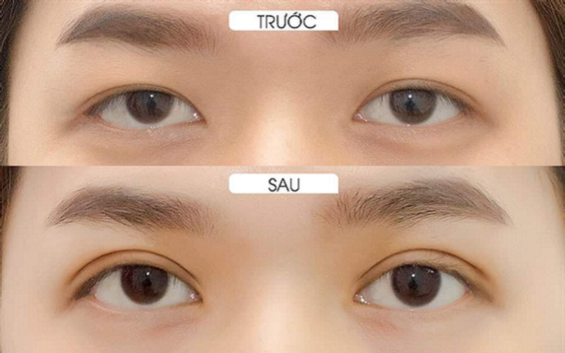 Những thắc mắc thường gặp liên quan đến cách chữa mắt sụp mí