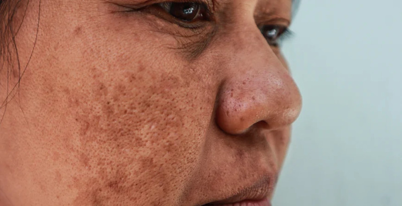 Ô nhiễm môi trường tác động rất lớn đến làn da