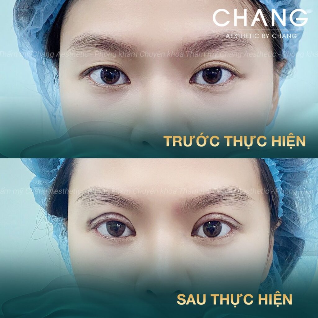 Cắt mí là phương pháp can thiệp phẫu thuật để tạo hình mắt 2 mí rõ đẹp