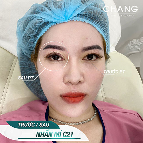 Nhấn mí không can thiệp phẫu thuật, chỉ dùng chỉ sinh học để tạo nếp mí