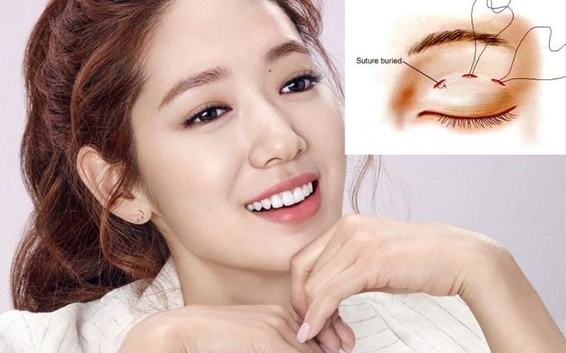 Bấm mí là tên gọi khác của nhấn mí, chỉ phương pháp tạo hình mắt 2 mí với chỉ sinh học