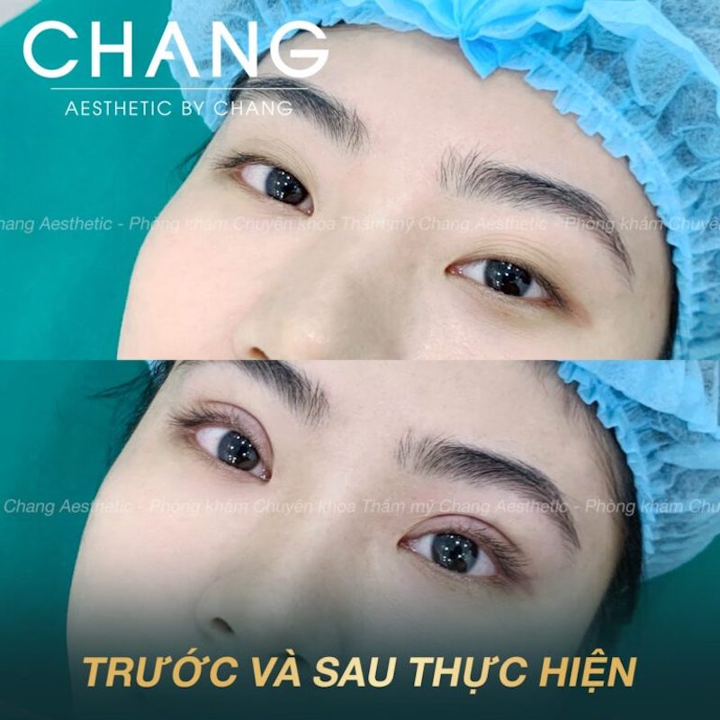 Phẫu thuật cắt mí Mini Deep mang lại hiệu quả vượt trội