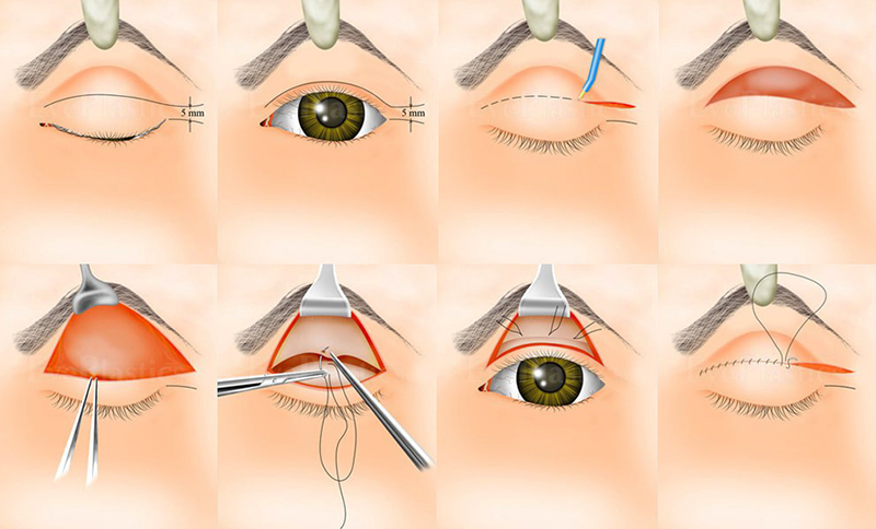 Phẫu thuật sụp mí mắt là giải pháp tốt nhất để khắc phục tình trạng sụp mí