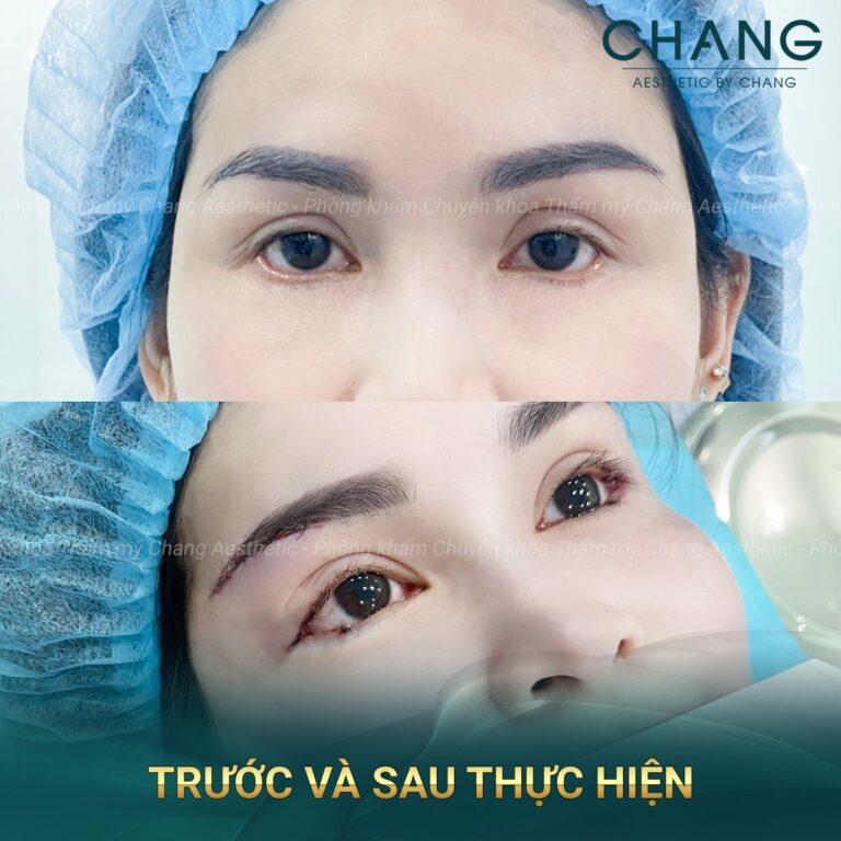 Nâng cung chân mày là một trong những cách chữa sụp mí hiệu quả