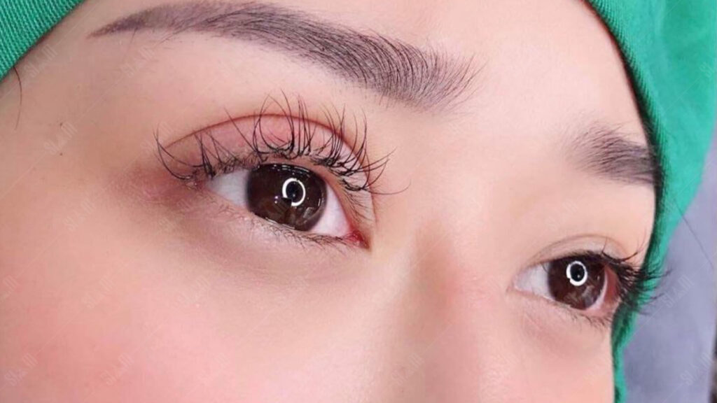 Chăm sóc đúng cách sẽ giúp mắt phục hồi nhanh sau phẫu thuật