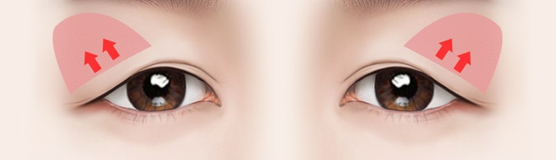 Sửa chữa nâng cơ mi mang lại nhiều lợi ích vượt trội