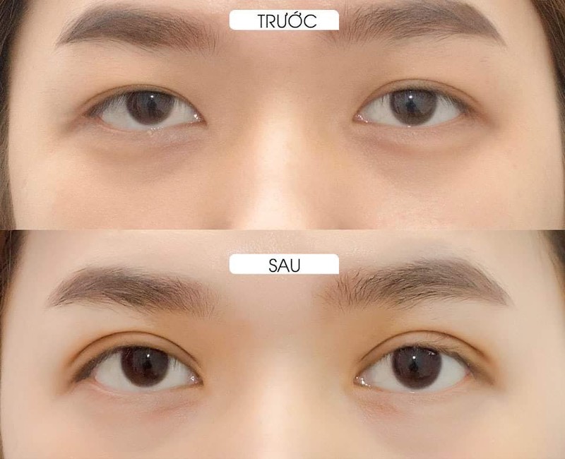 Thời điểm thích hợp sửa mí mắt là 3-6 tháng sau khi làm hỏng