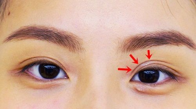 Xuất hiện nhiều nếp mí sau khi phẫu thuật cắt mí mắt